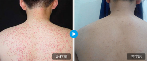 广州肤康皮肤病医院