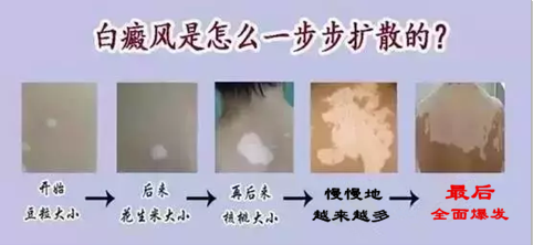 广州肤康皮肤病医院